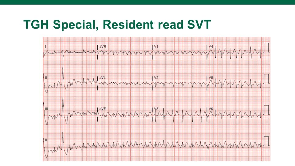 SVT on the ECG! — USF Emergency Medicine